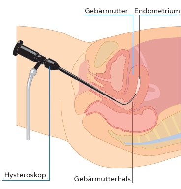 Hysteroskopie - Wie sie durchgeführt wird