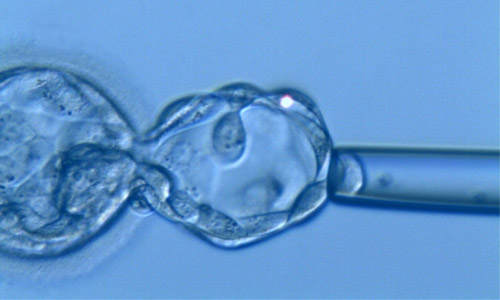 PID - Embryonenbiopsie im Blastozystenstadium